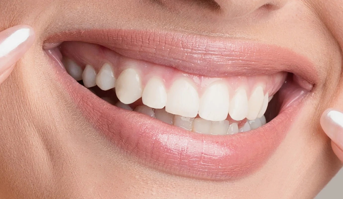 Sourire après une greffe de gencive