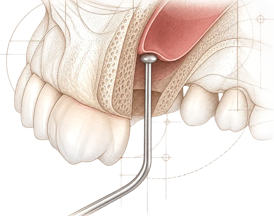 Sinus lift